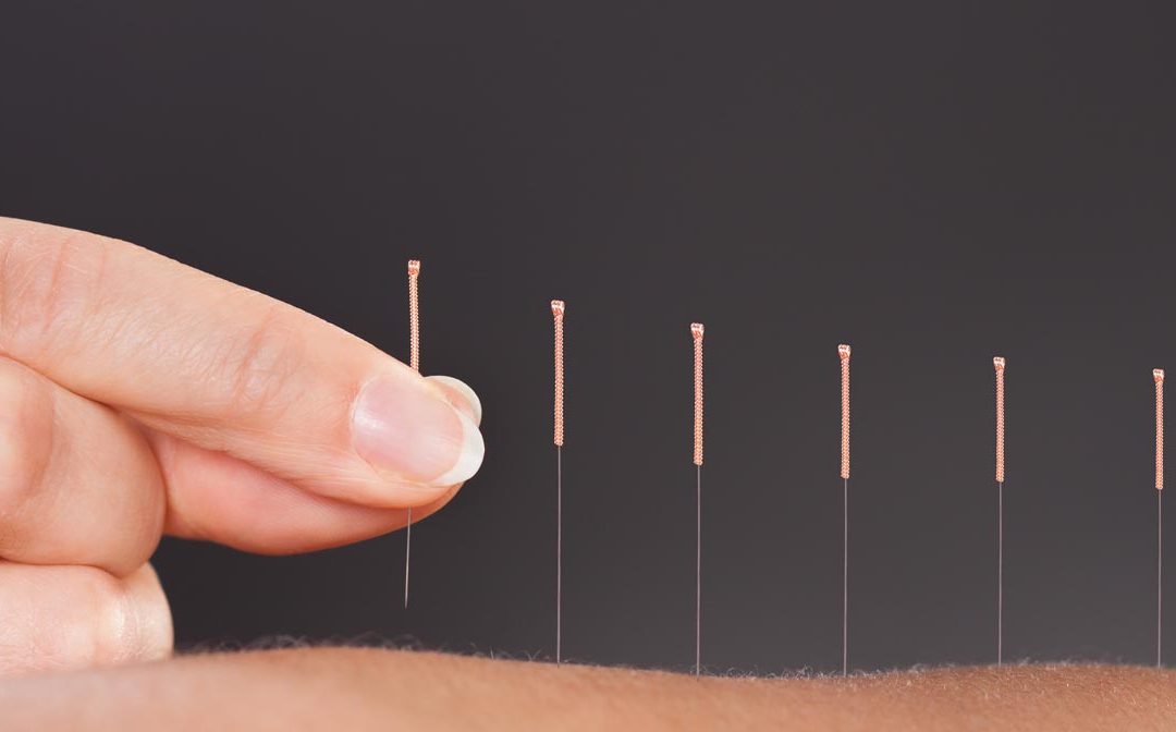 Pinpoint Acupuncture in Sartell MN